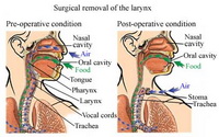 Cancer_of_the_larynx.jpg